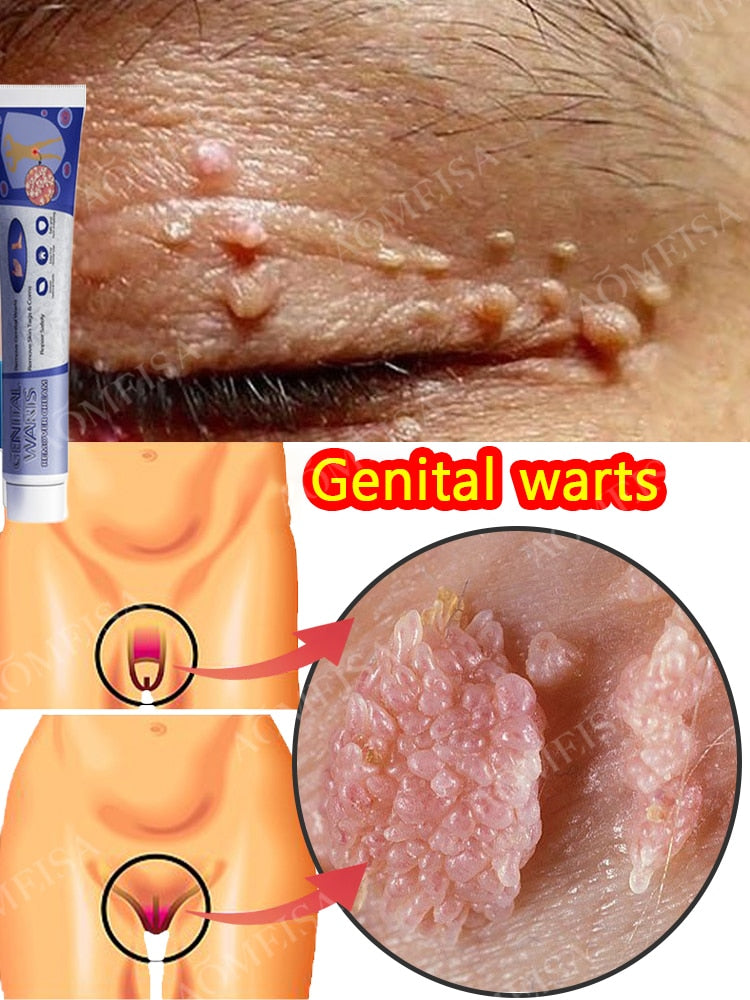 Eliminación de verrugas verrugas genitales hpv verrugas plantares verrugas ommon verruga plana etiqueta de la piel pomada removedora de verrugas